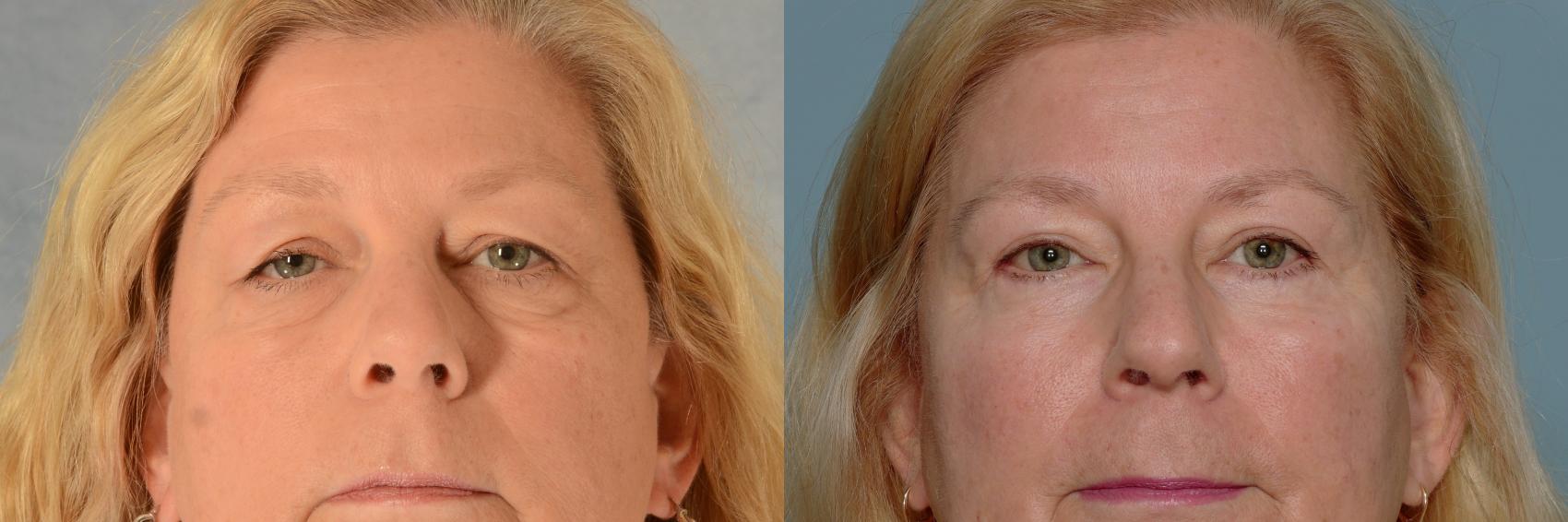 Before & After Eyelid Surgery (Blepharoplasty) Case 681 Front View in Tallahassee, FL
