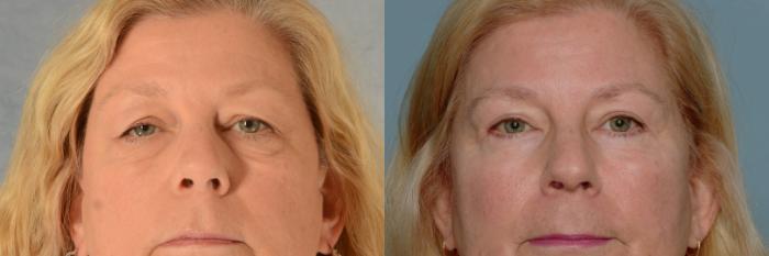 Before & After Eyelid Surgery (Blepharoplasty) Case 681 Front View in Tallahassee, FL