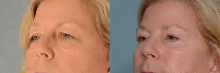 Before & After Eyelid Surgery (Blepharoplasty) Case 681 Left Oblique View in Tallahassee, FL