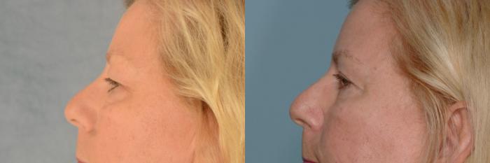 Before & After Eyelid Surgery (Blepharoplasty) Case 681 Left Side View in Tallahassee, FL