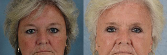 Before & After Eyelid Surgery (Blepharoplasty) Case 684 Front View in Tallahassee, FL