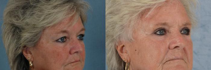 Before & After Eyelid Surgery (Blepharoplasty) Case 684 Right Oblique View in Tallahassee, FL