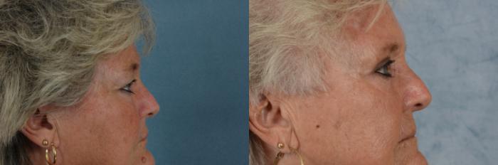 Before & After Eyelid Surgery (Blepharoplasty) Case 684 Right Side View in Tallahassee, FL