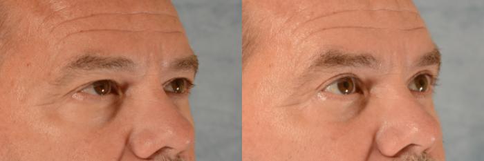 Before & After Eyelid Surgery (Blepharoplasty) Case 685 Right Oblique View in Tallahassee, FL