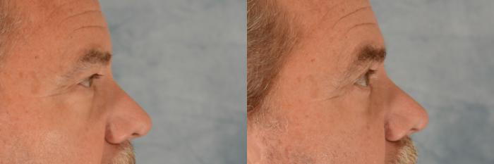 Before & After Eyelid Surgery (Blepharoplasty) Case 685 Right Side View in Tallahassee, FL