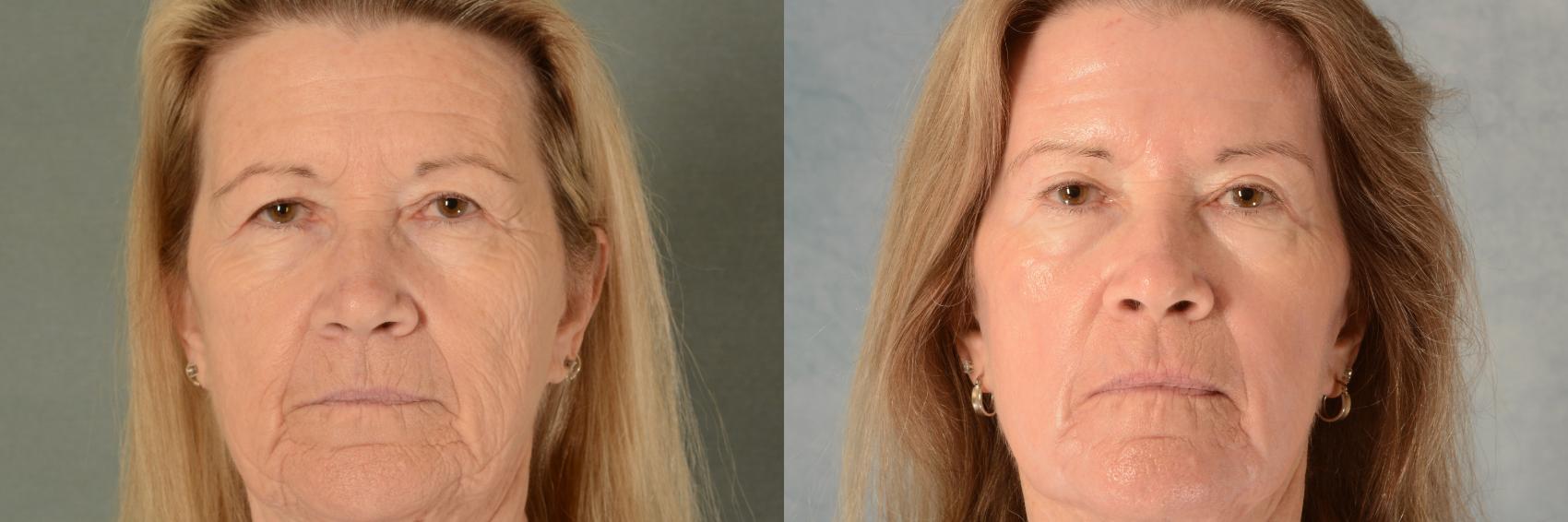 Before & After Eyelid Surgery (Blepharoplasty) Case 695 Front View in Tallahassee, FL