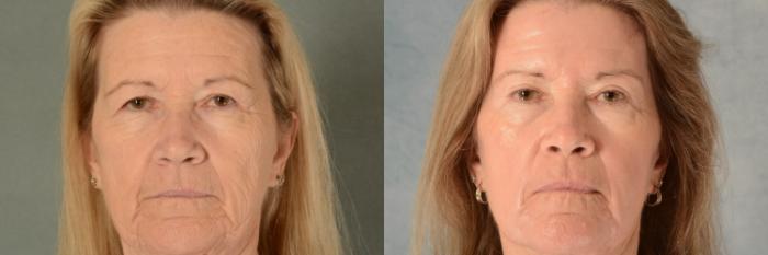 Before & After Eyelid Surgery (Blepharoplasty) Case 695 Front View in Tallahassee, FL