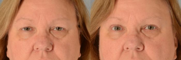 Before & After Eyelid Surgery (Blepharoplasty) Case 699 Front View in Tallahassee, FL