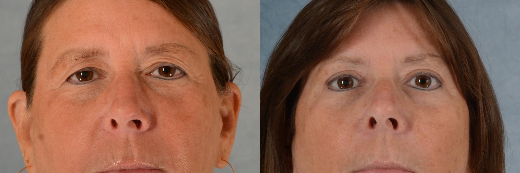 Before & After Eyelid Surgery (Blepharoplasty) Case 720 Front View in Tallahassee, FL