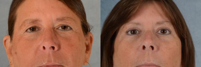 Before & After Eyelid Surgery (Blepharoplasty) Case 720 Front View in Tallahassee, FL