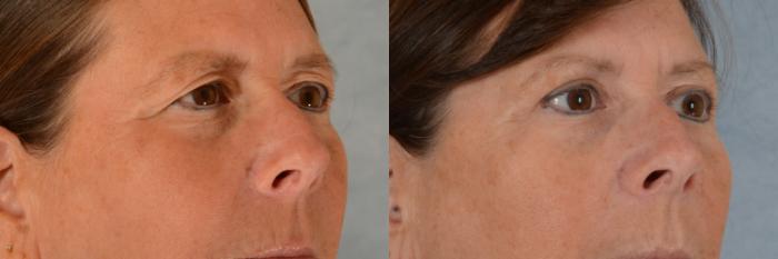 Before & After Eyelid Surgery (Blepharoplasty) Case 720 Right Oblique View in Tallahassee, FL