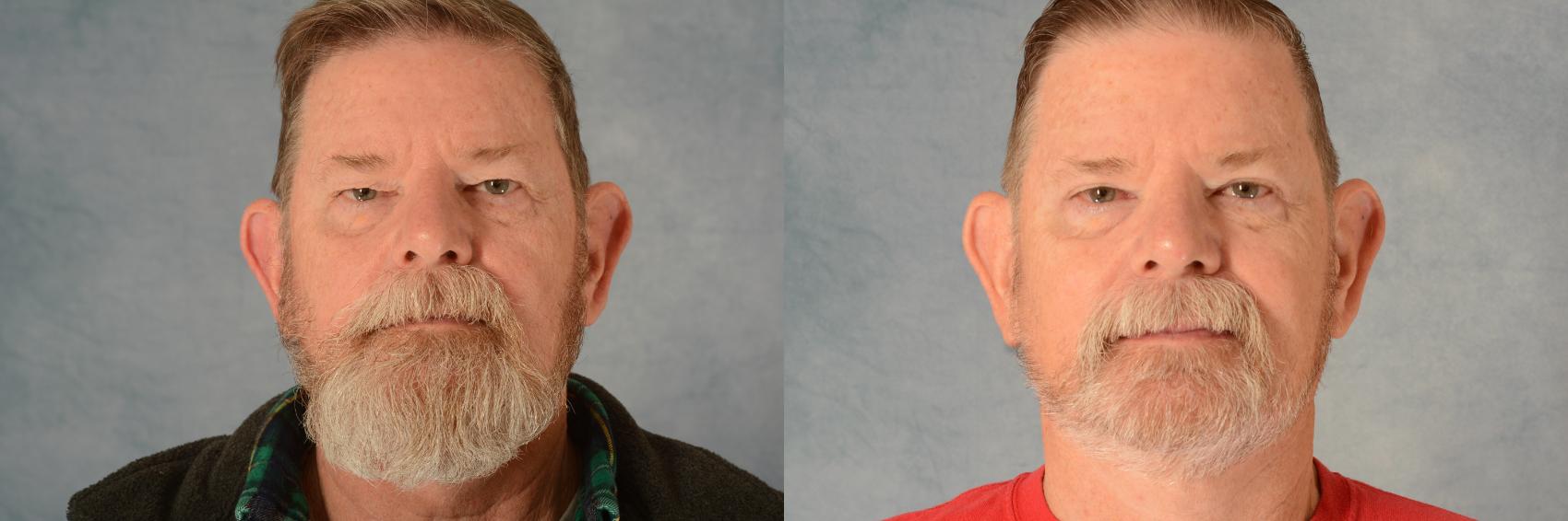 Before & After Eyelid Surgery (Blepharoplasty) Case 728 Front View in Tallahassee, FL