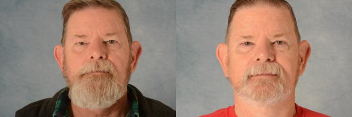 Before & After Eyelid Surgery (Blepharoplasty) Case 728 Front View in Tallahassee, FL