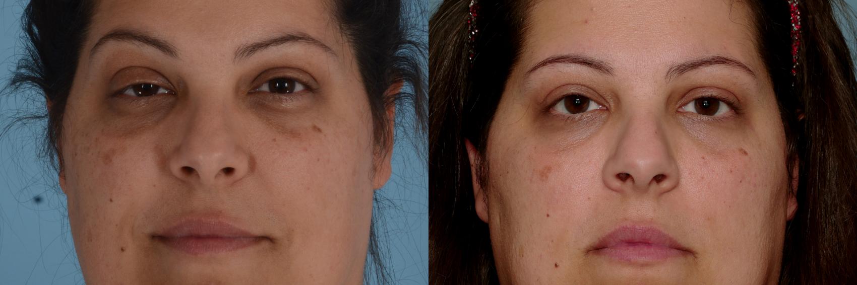 Before & After Eyelid Surgery (Blepharoplasty) Case 751 Front View in Tallahassee, FL
