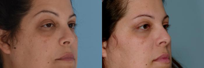 Before & After Eyelid Surgery (Blepharoplasty) Case 751 Right Oblique View in Tallahassee, FL