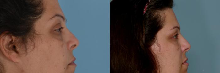 Before & After Eyelid Surgery (Blepharoplasty) Case 751 Right Side View in Tallahassee, FL