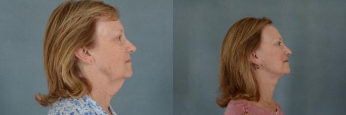 Before & After Facelift Case 259 View #2 View in Tallahassee, FL
