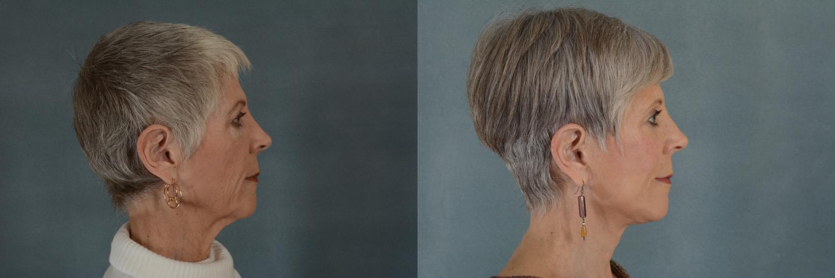 Before & After Facelift Case 263 View #2 View in Tallahassee, FL