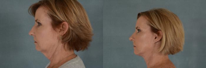 Before & After Facelift Case 315 View #2 View in Tallahassee, FL