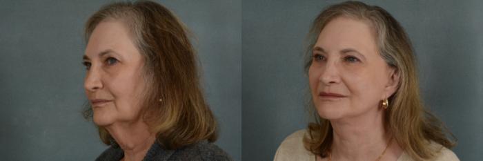 Before & After Facelift Case 337 View #2 View in Tallahassee, FL