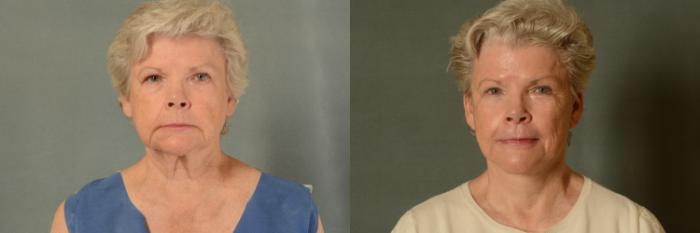 Before & After Facelift Case 387 View #1 View in Tallahassee, FL