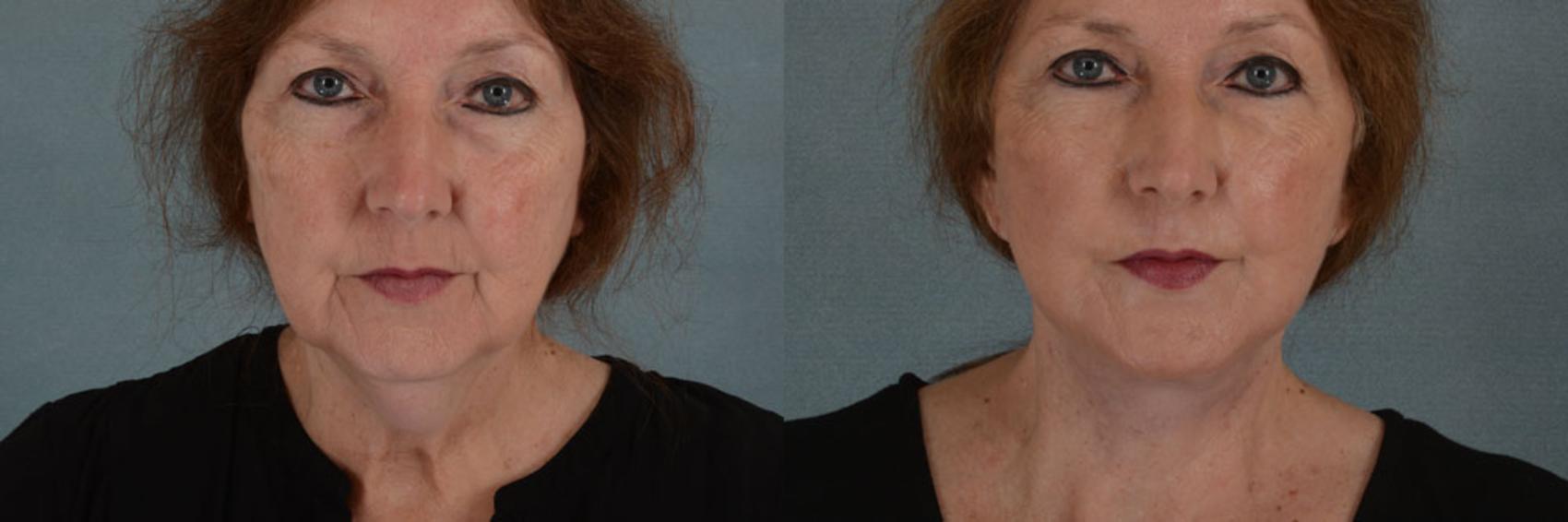 Before & After Facelift Case 45 View #1 View in Tallahassee, FL