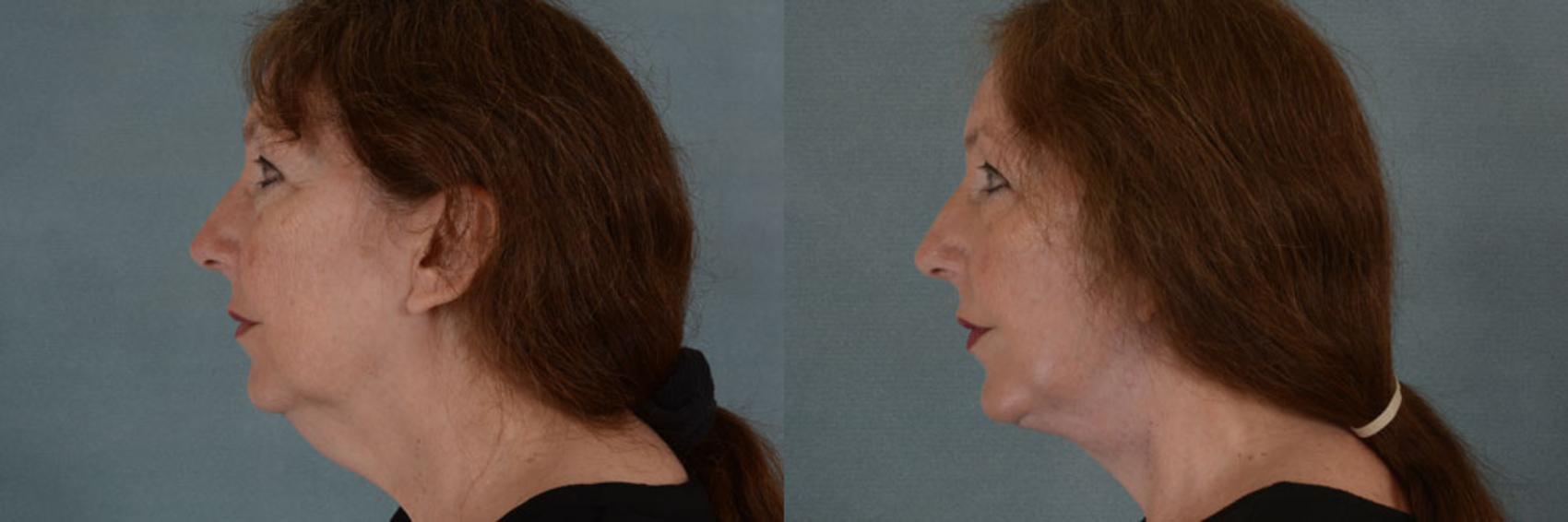 Before & After Facelift Case 45 View #2 View in Tallahassee, FL