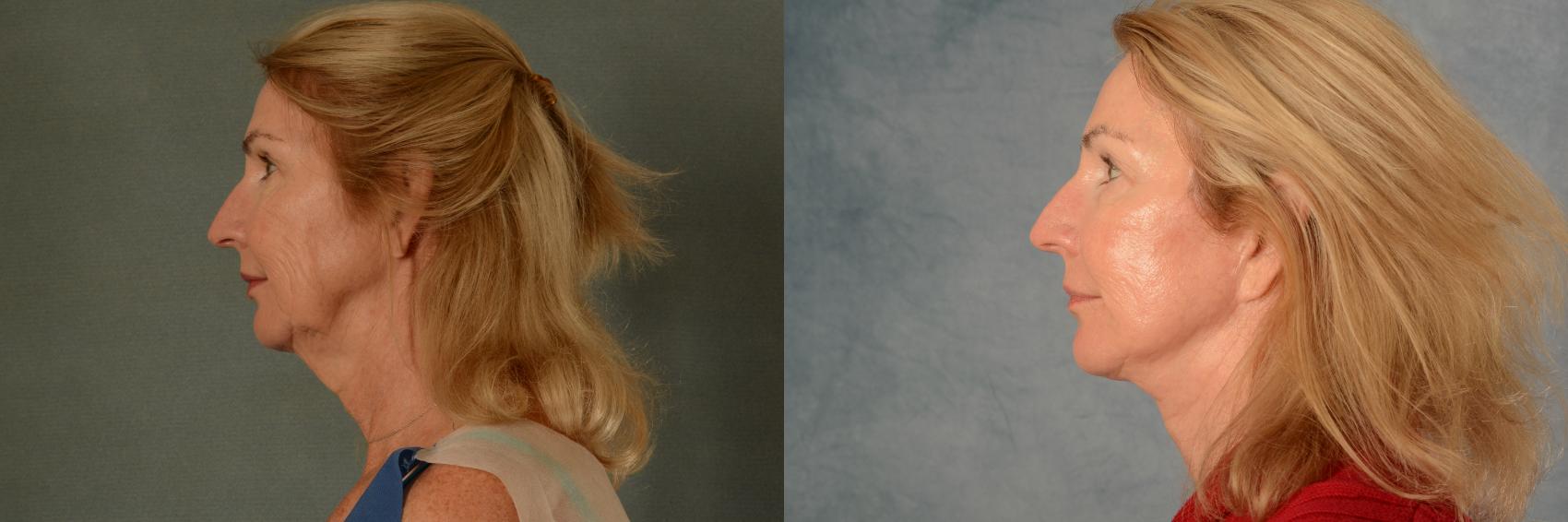 Before & After Facelift Case 471 Left Side View in Tallahassee, FL