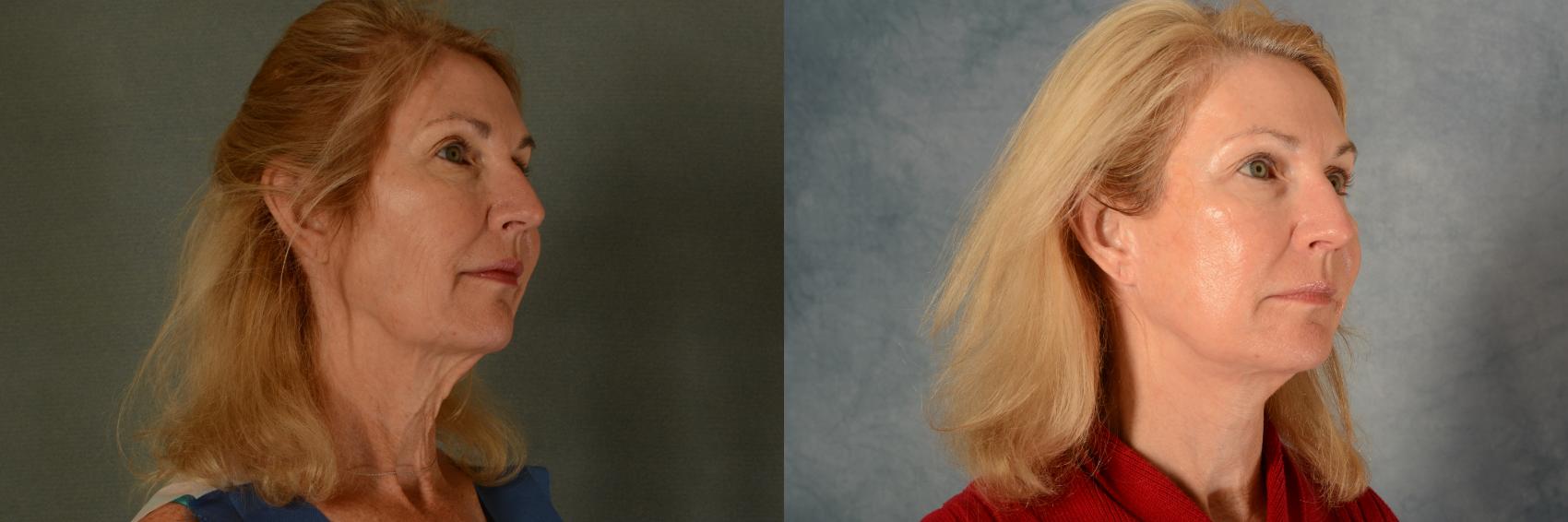 Before & After Facelift Case 471 Right Oblique View in Tallahassee, FL