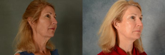 Before & After Facelift Case 471 Right Oblique View in Tallahassee, FL