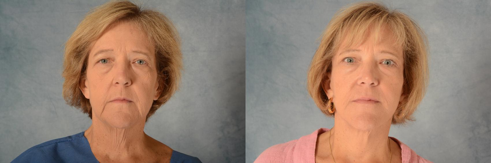 Before & After Facelift Case 497 Front View in Tallahassee, FL