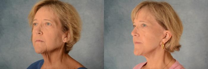 Before & After Facelift Case 497 Left Oblique View in Tallahassee, FL