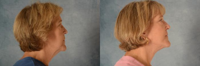 Before & After Facelift Case 497 Right Side View in Tallahassee, FL