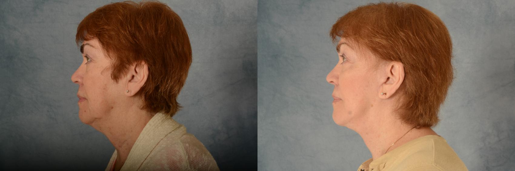 Before & After Facelift Case 499 Left Side View in Tallahassee, FL