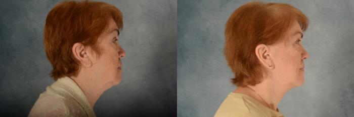 Before & After Facelift Case 499 Right Side View in Tallahassee, FL