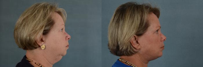 Before & After Facelift Case 50 View #2 View in Tallahassee, FL