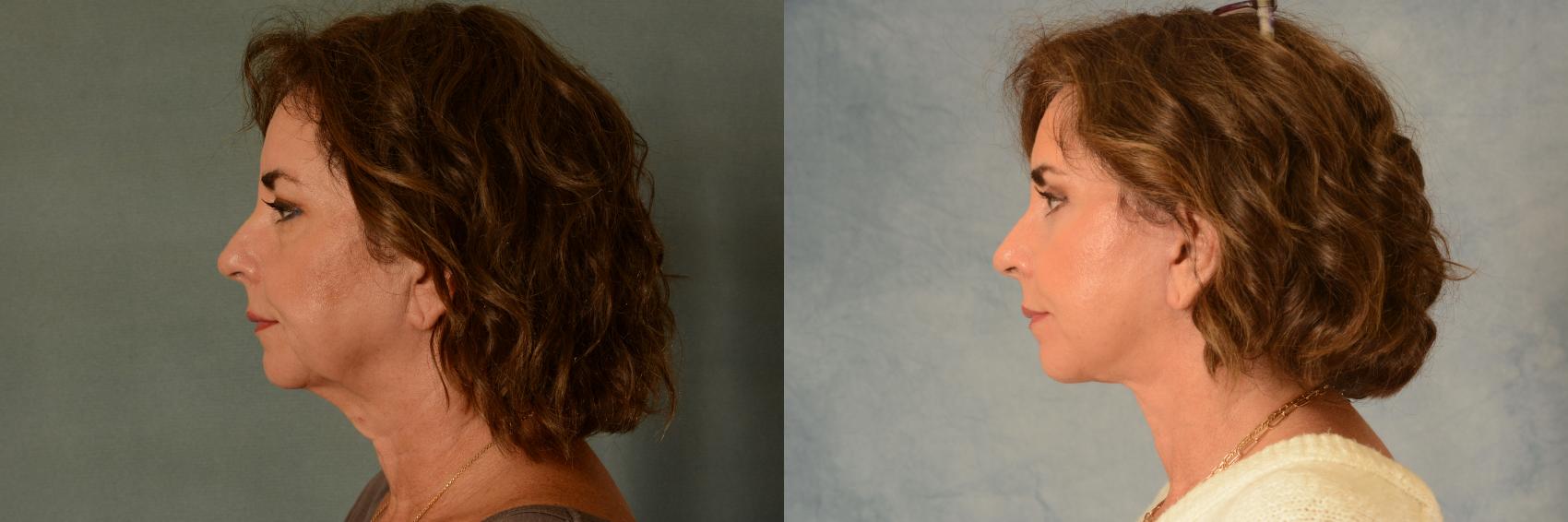 Before & After Facelift Case 507 Left Side View in Tallahassee, FL
