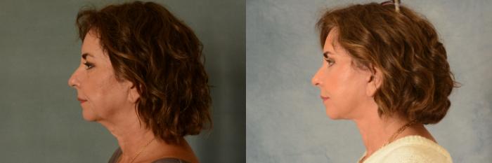Before & After Facelift Case 507 Left Side View in Tallahassee, FL