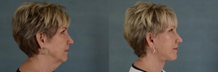 Before & After Facelift Case 56 View #2 View in Tallahassee, FL