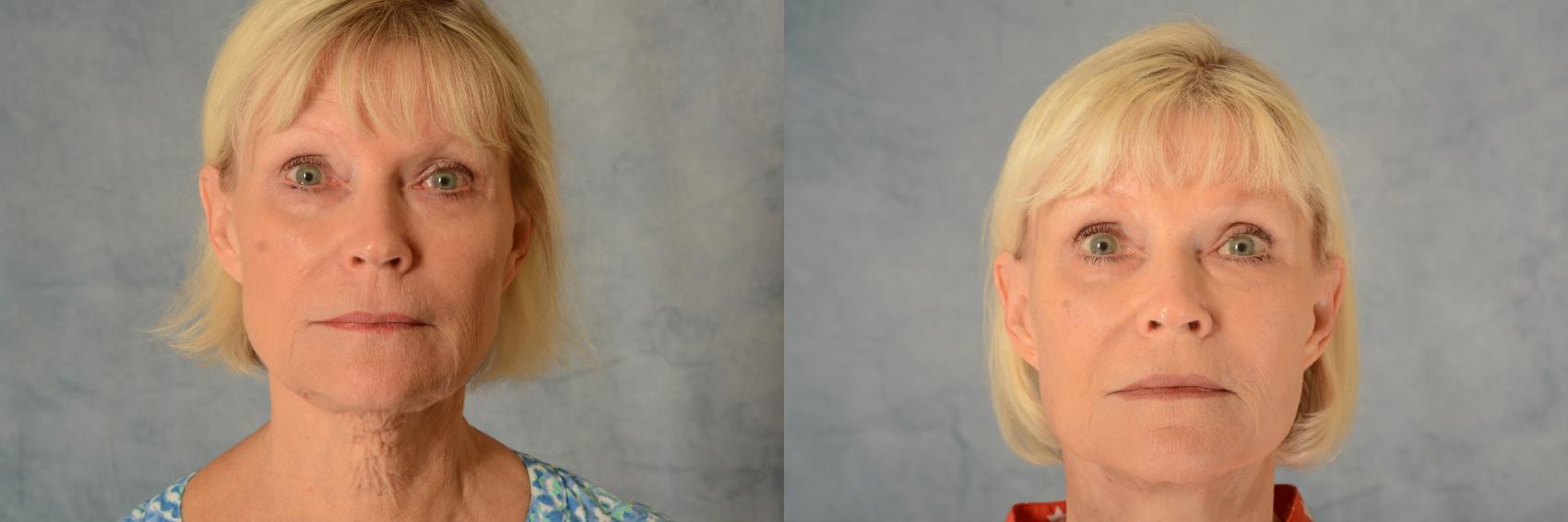 Before & After Facelift Case 561 Front View in Tallahassee, FL