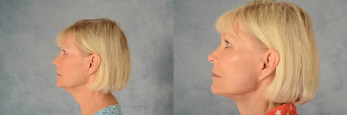 Before & After Facelift Case 561 Left Side View in Tallahassee, FL