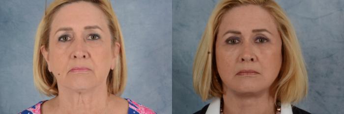 Before & After Facelift Case 608 Front View in Tallahassee, FL