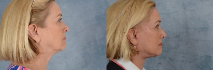 Before & After Facelift Case 608 Right Side View in Tallahassee, FL