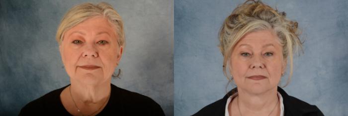 Before & After Facelift Case 611 Front View in Tallahassee, FL