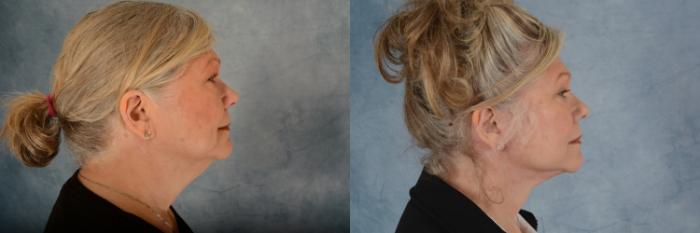 Before & After Facelift Case 611 Right Side View in Tallahassee, FL