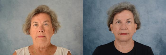 Before & After Facelift Case 630 Front View in Tallahassee, FL