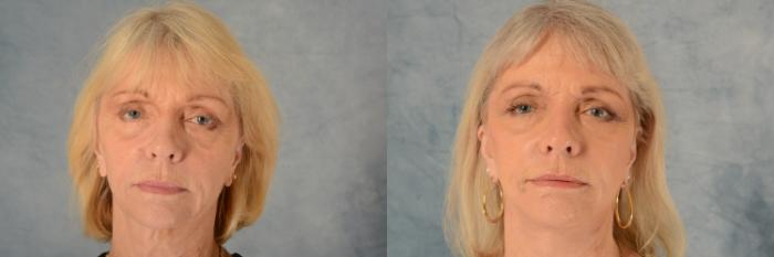 Before & After Facelift Case 631 Front View in Tallahassee, FL
