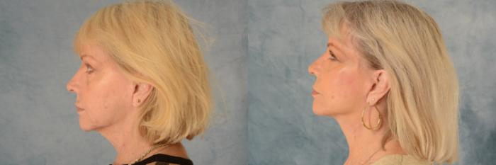 Before & After Facelift Case 631 Left Side View in Tallahassee, FL