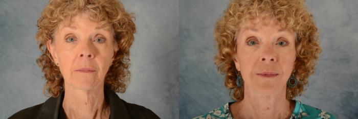 Before & After Facelift Case 632 Front View in Tallahassee, FL