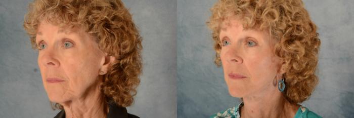 Before & After Facelift Case 632 Left Oblique View in Tallahassee, FL